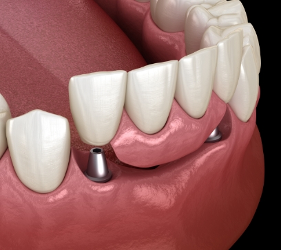 Animated hybridge dental implant bridge placement