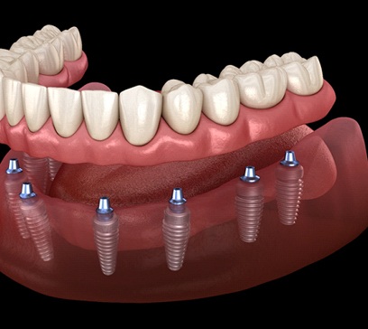 A digital image of 6 dental implants surgically placed along the lower arch and an implant denture placed on top in Bethel Park