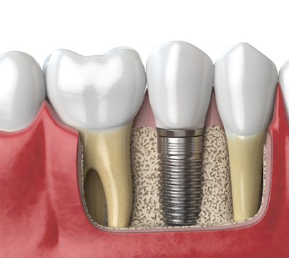 Diagram showing how dental implants in Bethel Park work