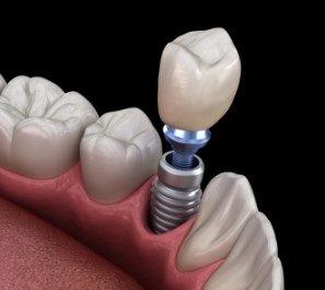 Animated dnetal implant supported dental crown placement