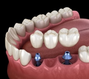 Animated dental implant supported fixed bridge placement