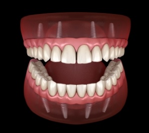 Animated dental implant supported denture placement