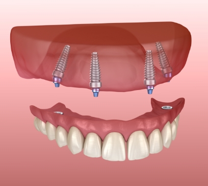 Animated all on four dental implant dentures placement