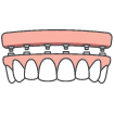 Animated dental implant supported denture placement