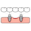 Animated dental implant hybridge denture placement