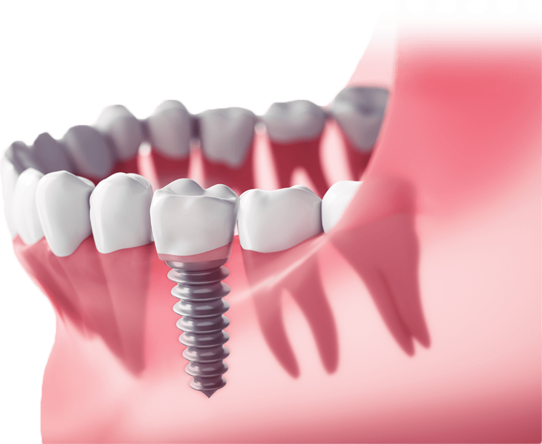 Animated smile with dental implant supported replacement tooth