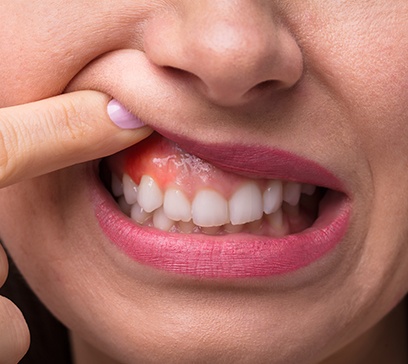 Closeup of smile with inflamed soft tissue during periodontal diagnostics exam