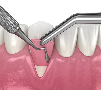 Animated smile during gum grafting