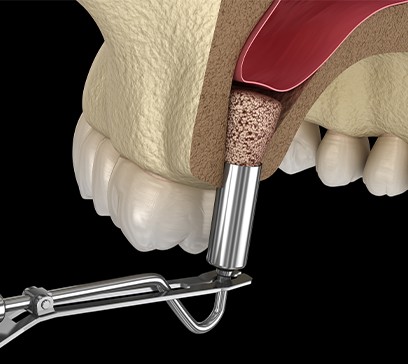 Animated smile during bone grafting