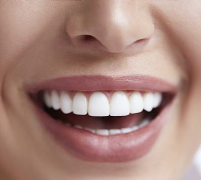 Closeup of smile after crown lengthening