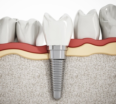 Animated smile with dental implant placed after osseous surgery