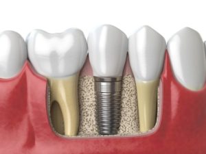 diagram of dental implants in Bethel Park after bone graft